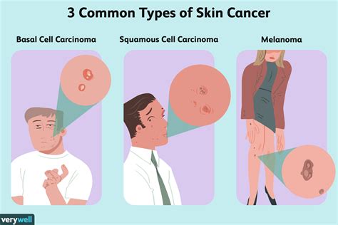What Cause Cancer Of The Skin